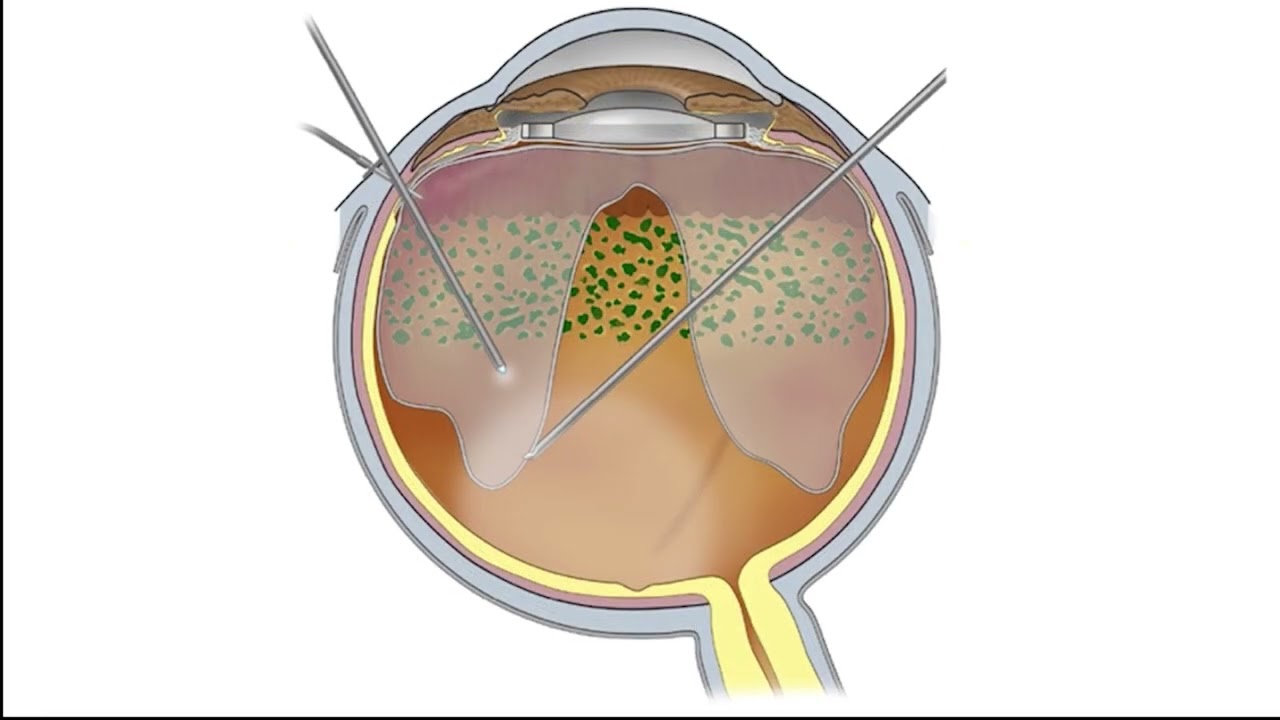 Vitrectomy as a Prevention for Retinal Detachment in High-Risk Eyes &ndash; Video abstract [530665]