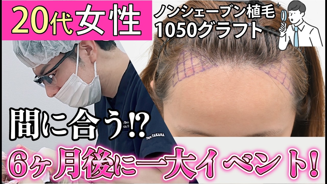 【20代女性の自毛植毛】「おでこのM字を埋めた」リアルな症例と、術後6ヶ月までの経過を大公開！