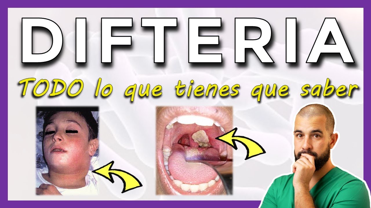 DIFTERIA - Corynebacterium diphtheriae - ¿Qué es? Contagio Síntomas Diagnóstico Tratamiento Vacuna