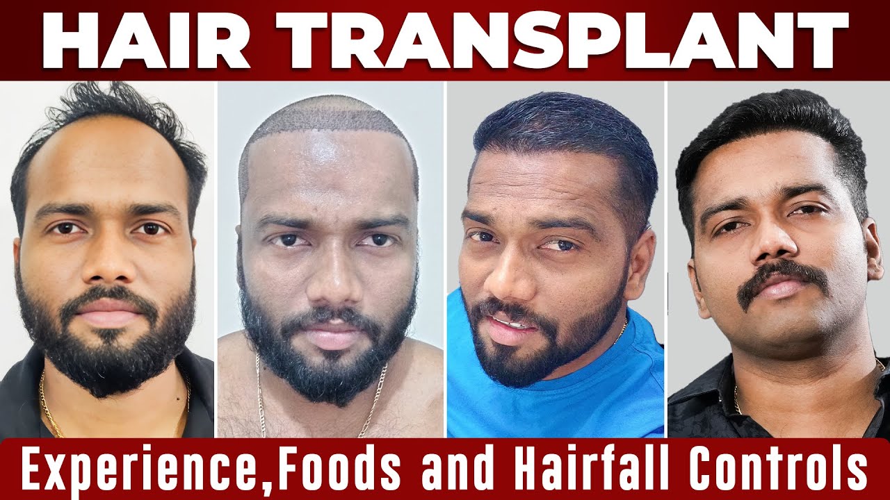 MY HAIR TRANSPLANT EXPERIENCE🥸