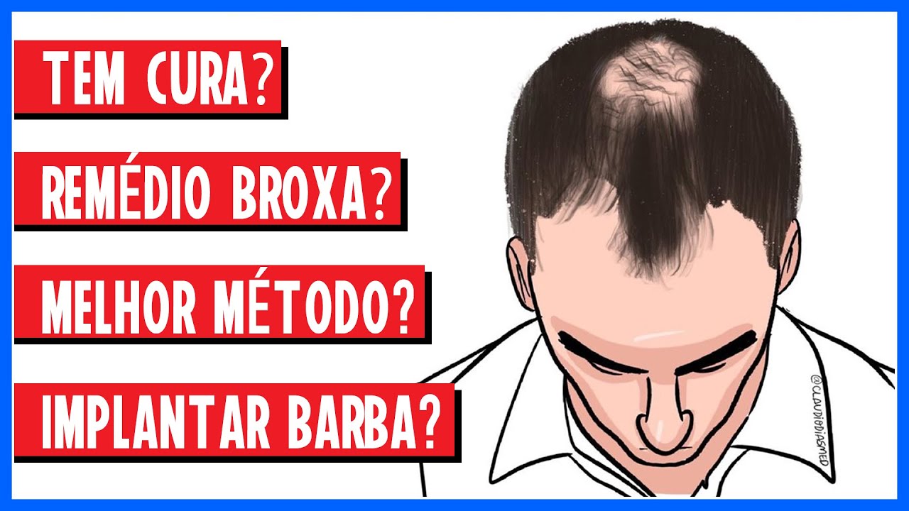 CALVÍCIE e IMPLANTE CAPILAR: Dura? Melhor método? Remédio BROXA?  Implantar BARBA? - Gays Anatomy