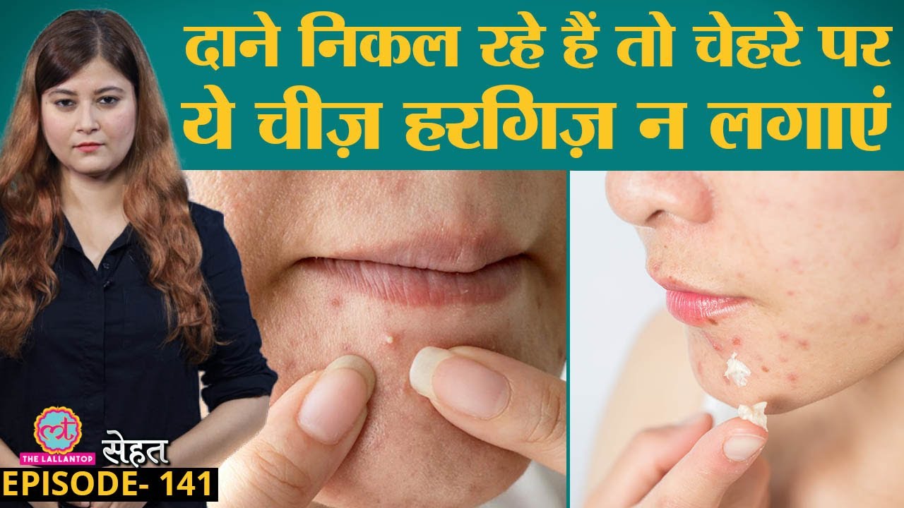 Acne, Pimples, दानों को बिना निशान ठीक करना है तो ये गलतियां ना करें | Sehat ep 141