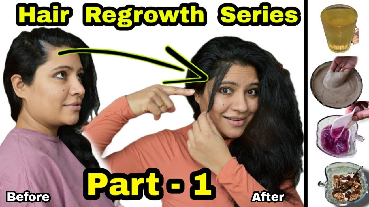 Hair Regrowth Series : Part - 1 Regrow Lost Hair & Receding Hairline खोये हुए बाल वापस उगायें।