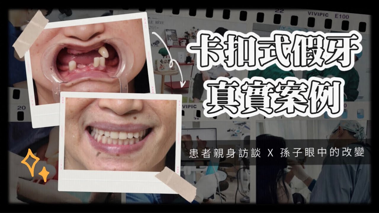 「阿嬤真的變漂亮了」卡扣式假牙真實訪談｜從活動假牙到卡扣式假牙的改變｜東嶼牙醫