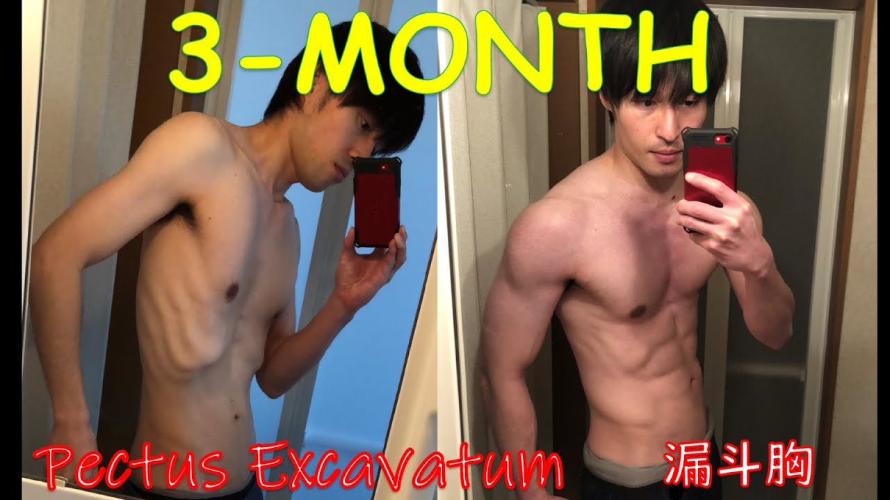 【Pectus Excavatum】3-Month Body Transformation【漏斗胸】ガリガリ克服筋トレ！～3か月間の成果～