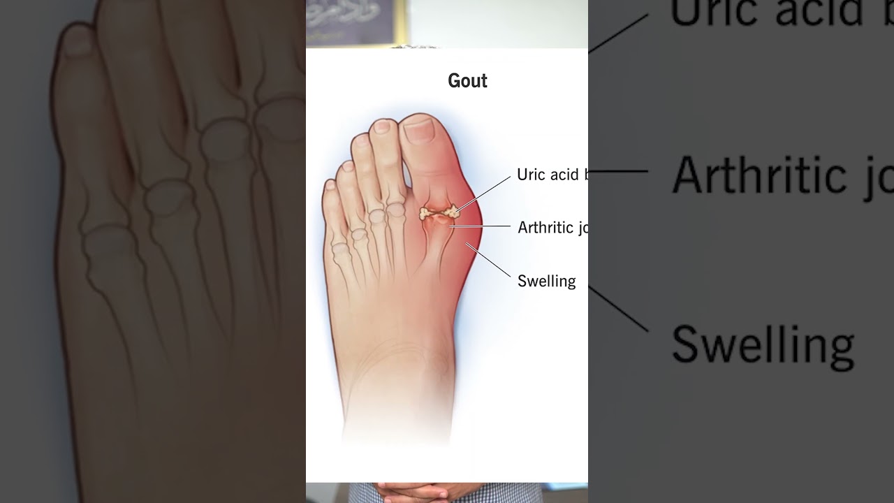 High Uric Acid & Gout Pain in Big Toe | Causes & Treatment | Dr Abdul Hannan
