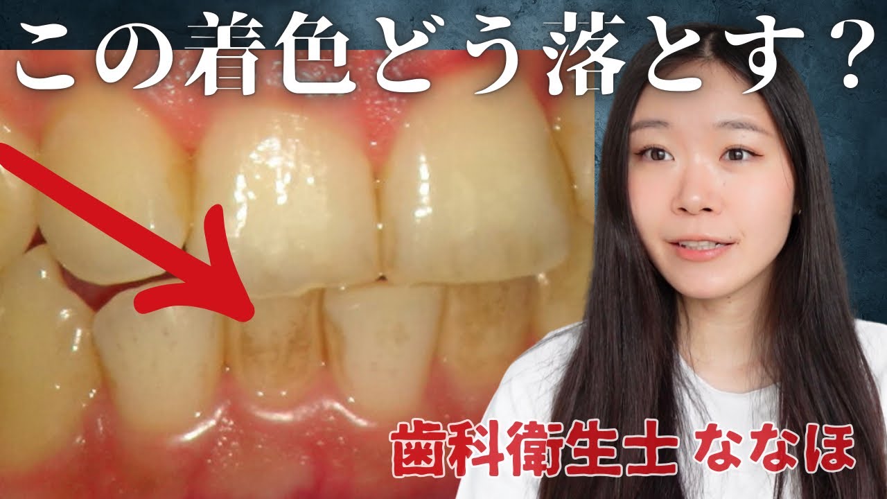 着色を落とす方法と着色防止のコツを歯科衛生士が解説します。