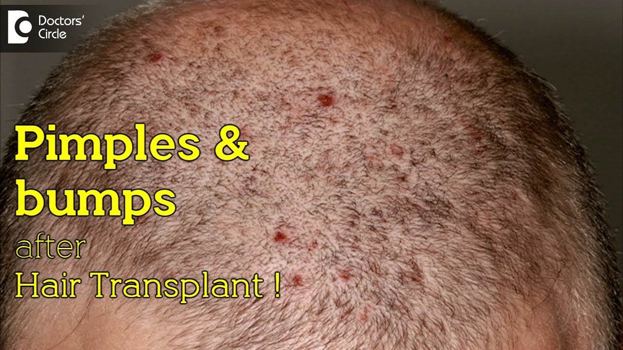 Pimples and bumps on transplanted hair and donor area after hair transplant - Dr. Deepak P Devakar