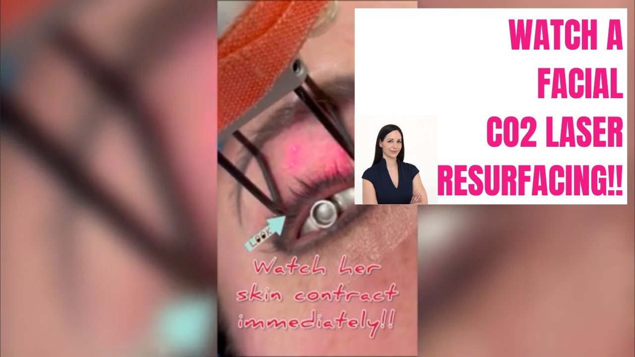 CO2 Laser Resurfacing: Tighten Skin & Erase Wrinkles with Dr. Megan Jack ✨