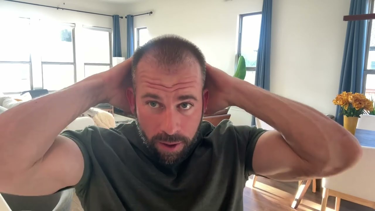 1 month check-in for Cosmedica hair transplant