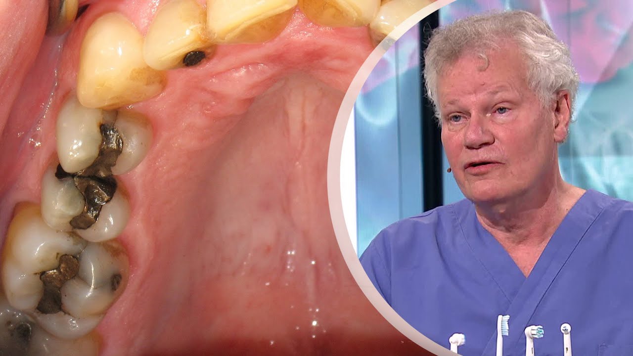 De sönderborrade generationerna – lagades med amalgam  - Malou Efter tio (TV4)
