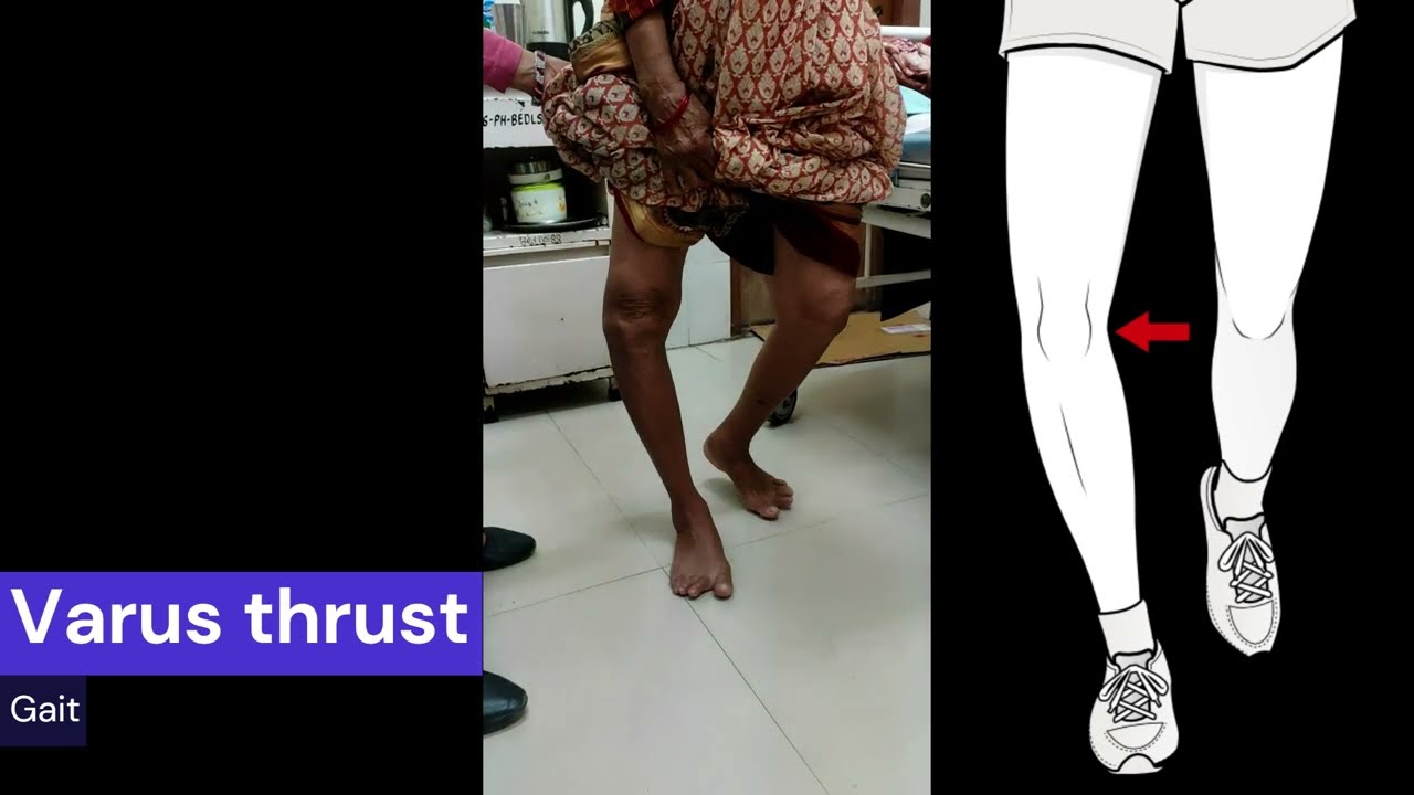 Varus thrust gait