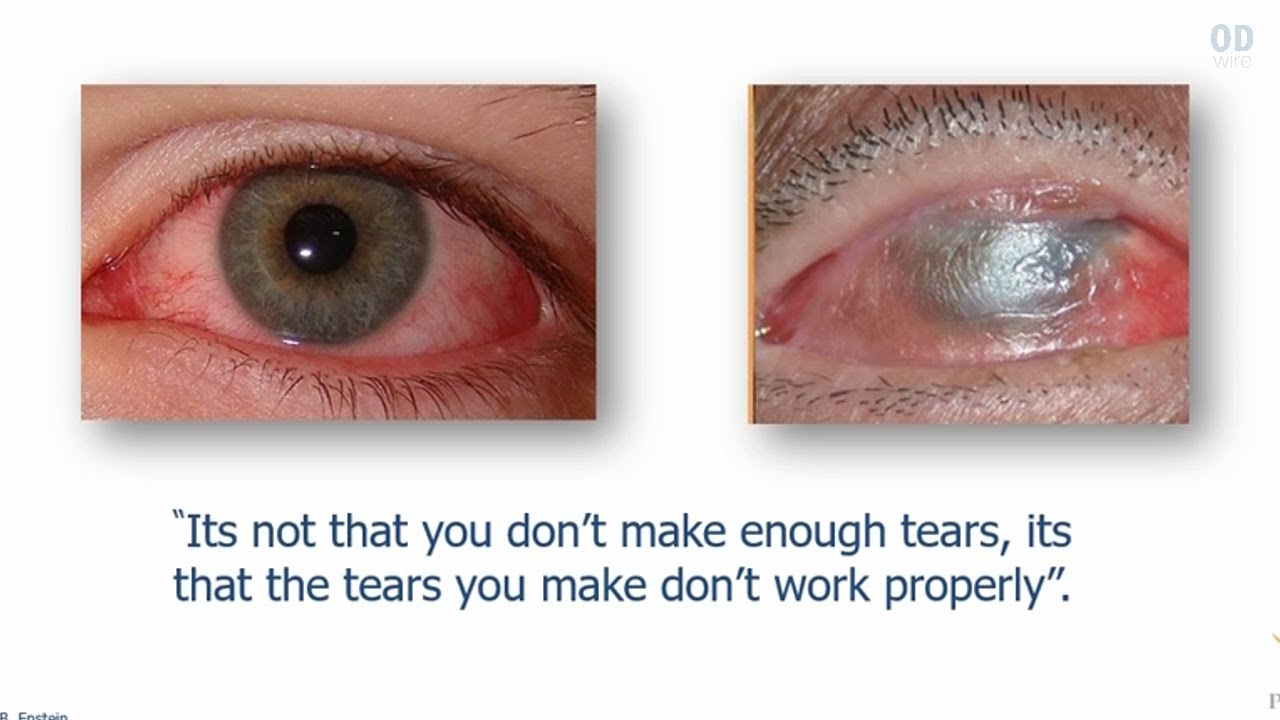 Making the Complex Simple: A Comprehensive Approach to Dry Eye Mastery