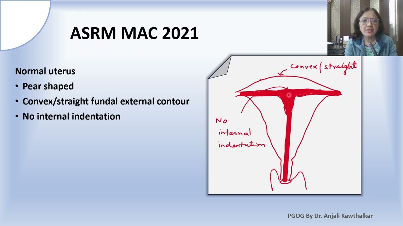 Мюллеровы аномалии – новая классификация ASRM MAC 2021, подготовленная доктором Анджали Кавталкар.