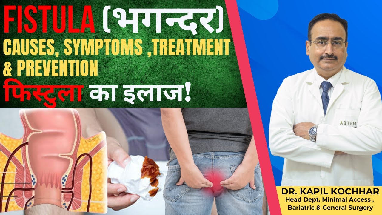 FISTULA - CAUSES, TREATMENT , PREVENTION AND CURE | भगंदर, Fistula का इलाज | Dr.Kapil Kochhar