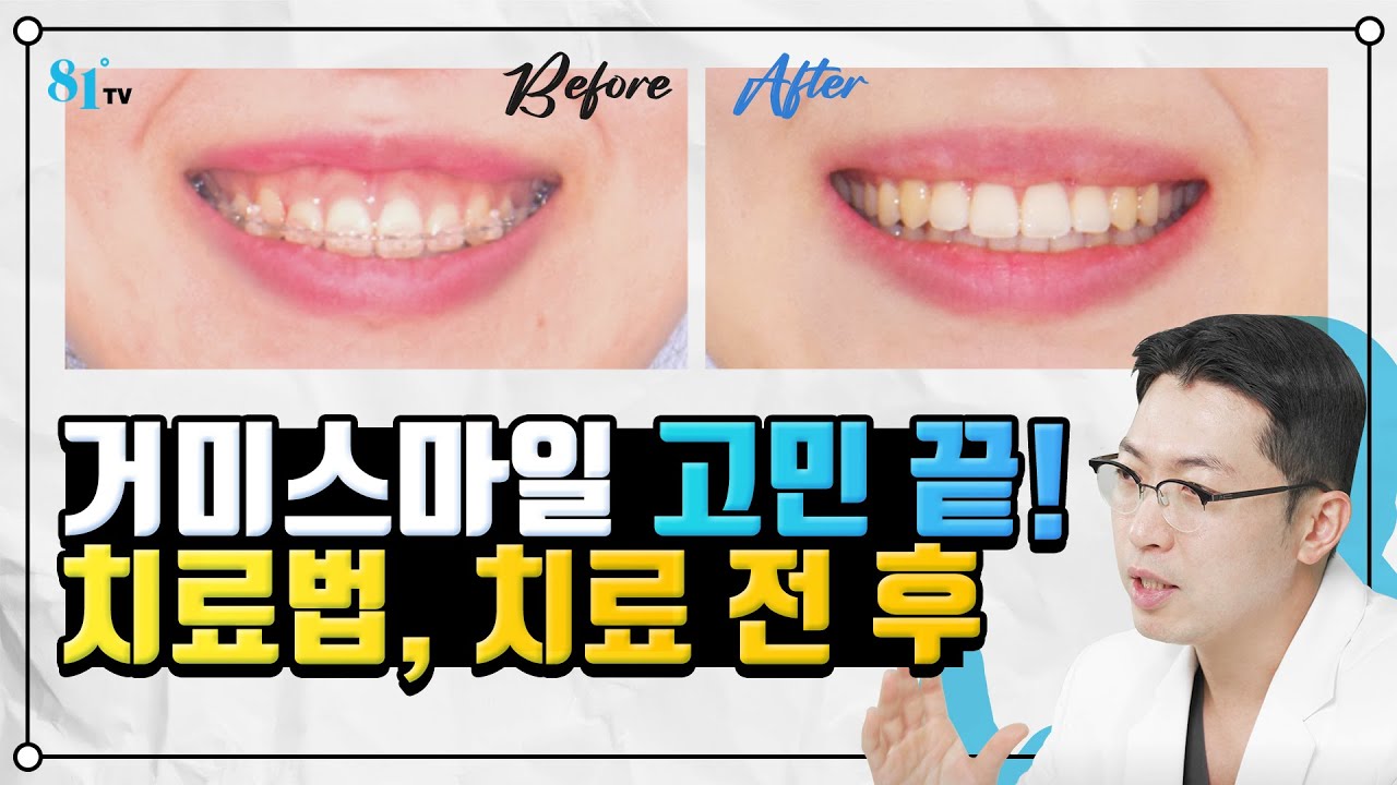 거미스마일 교정 잇몸성형. 원리와 치료 전후 까지 총 정리 해드립니다!