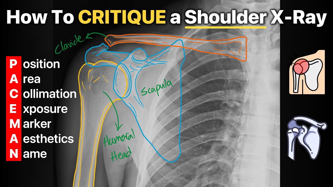 How To Critique a Shoulder X-Ray!