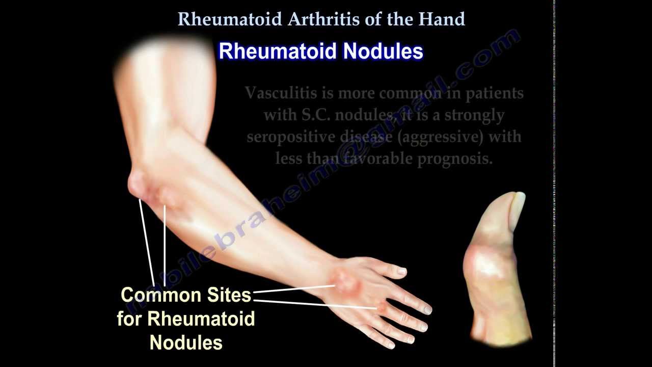 Rheumatoid Arthritis of the hand - Everything You Need To Know - Dr. Nabil Ebraheim