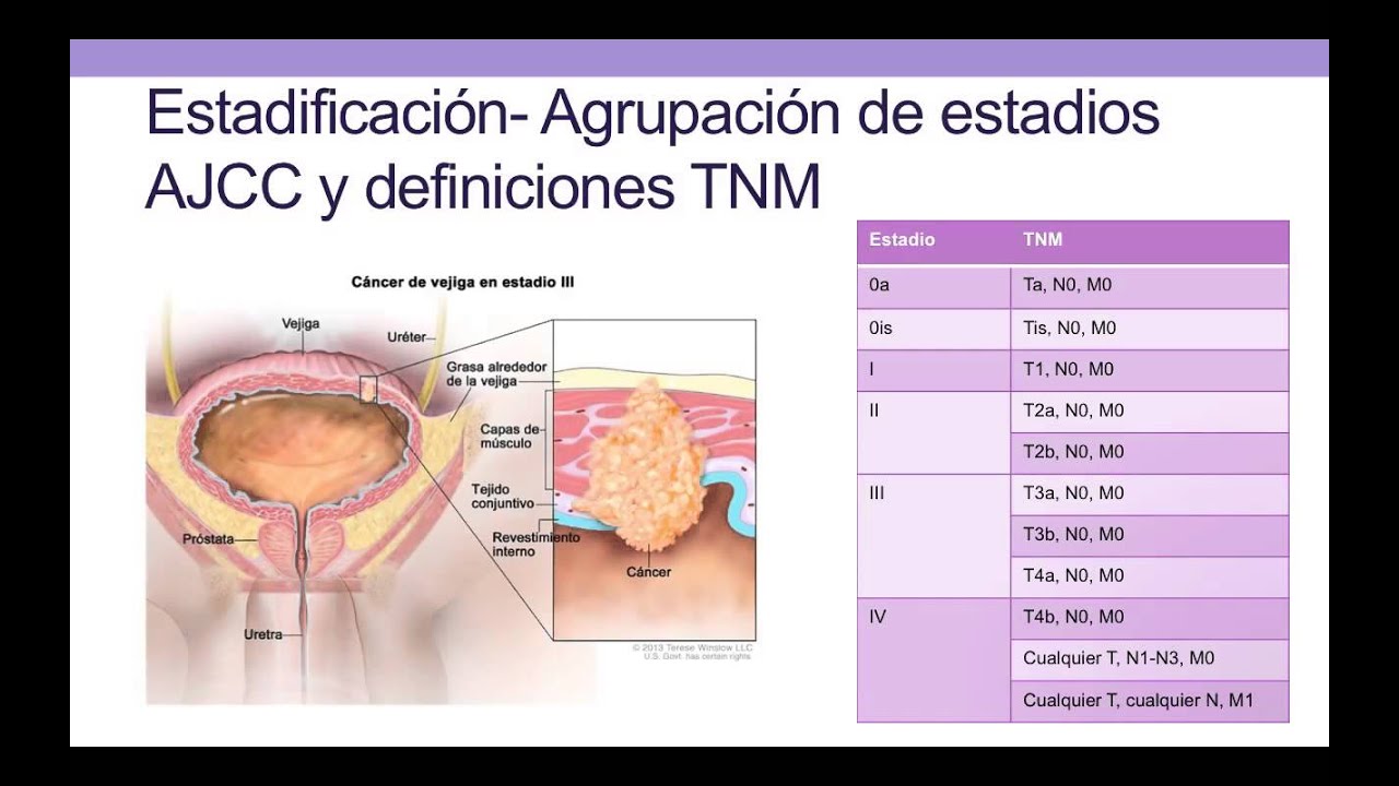 Cancer de Vejiga