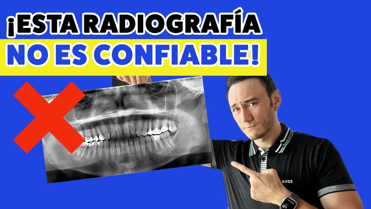 Esta radiografía NO ES CONFIABLE para diagnosticarte | Se pueden cometer errores.