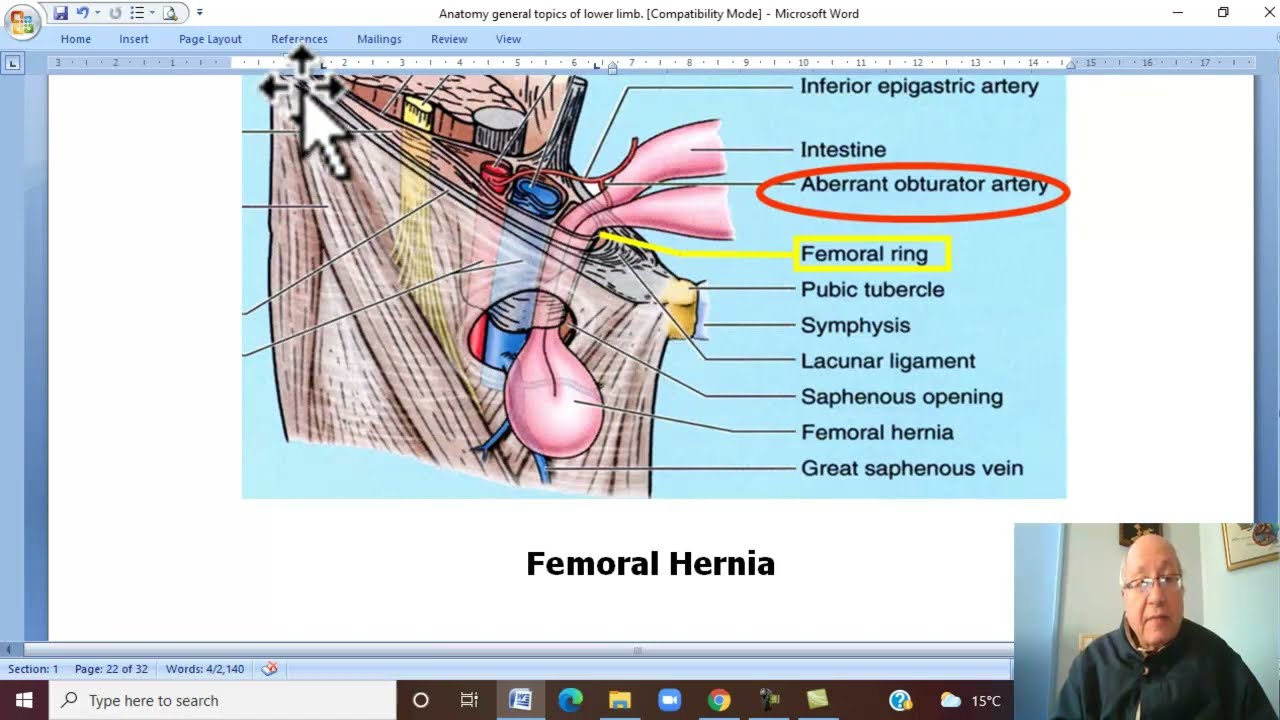 Musculo-skeletal Module , Anatomy of Lower Limb in Arabic 40 ( Femoral canal  and hernia)  Wahdan