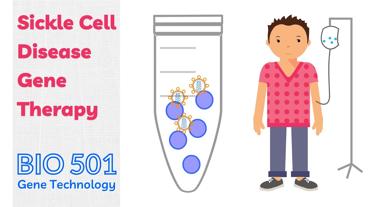 Gene Therapy for Sickle Cell Disease - Modification of Stem Cells
