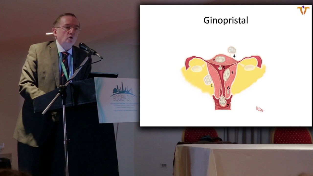Novedades en el Tratamiento No Quirúrgico de los Miomas