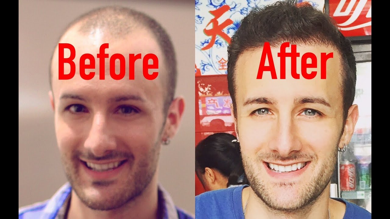 ENTIRE Hair Transplant Surgery Video - Beginning to End