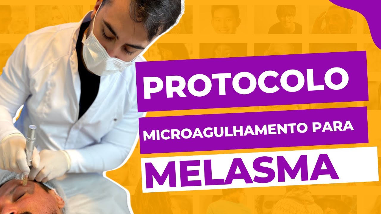 Protocolo Microagulhamento para Melasma com Nano Ozonioterapia - por Heitor Cruz