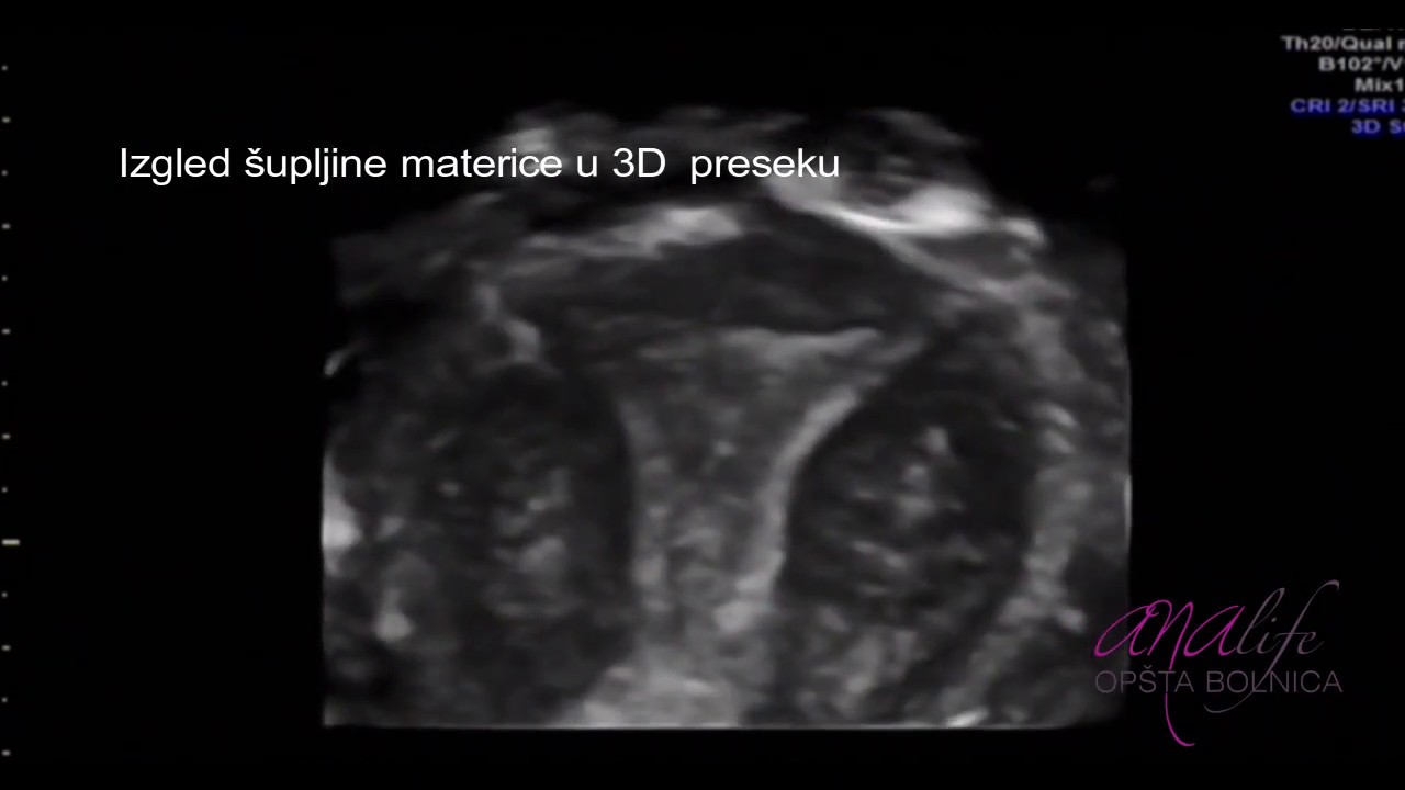 KAKO OTKRITI POLIP U MATERICI? 2D/3D ULTRAZVUK MALE KARLICE - Analife- dr Vojislav Živanić