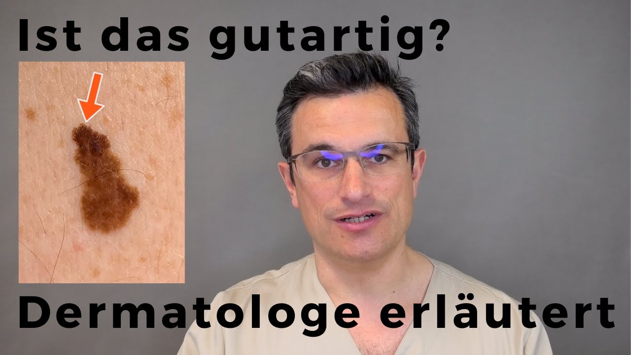 Wie erkenne ich, ob ein MUTTERMAL GUTARTIG ist? Der Dermatologe Dr. Kasten  erkl&auml;rt, was wichtig ist