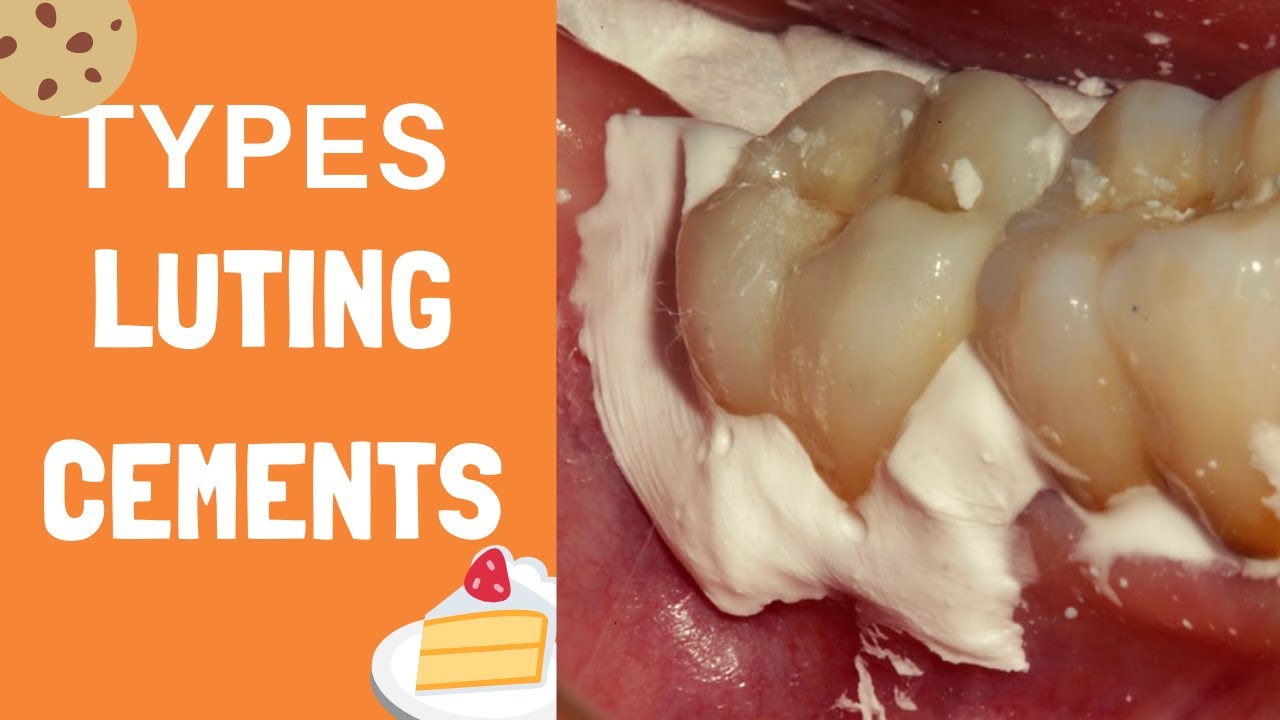 Types of Dental Luting Cement For Crown, Bridge, Veneer, Implant- Cementation in #dentistry