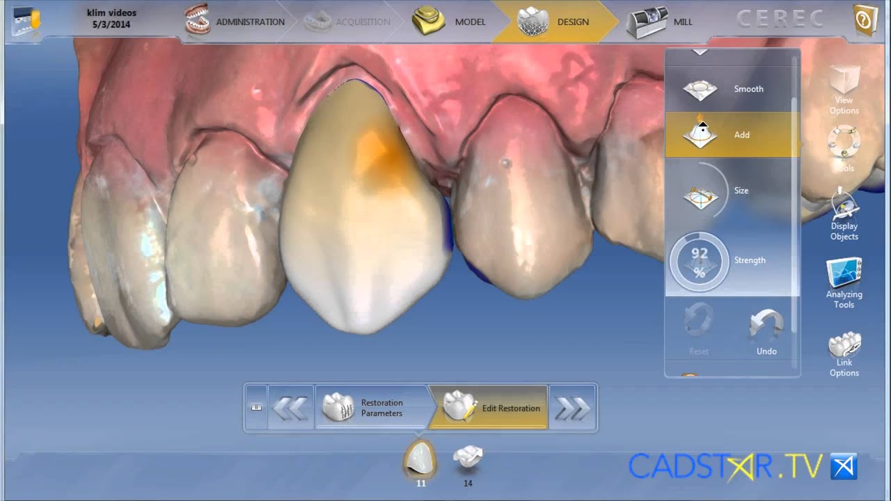 CEREC 4.3 Software Overview