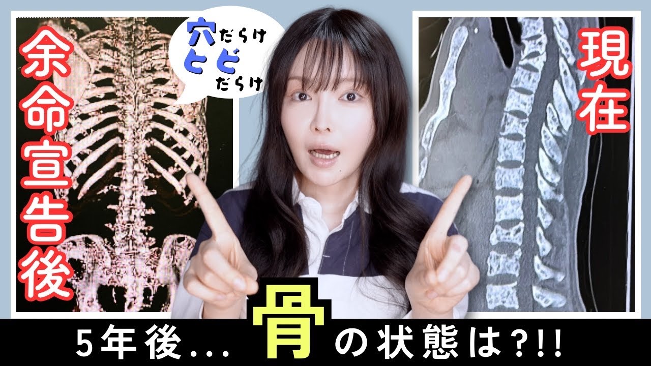 【乳がん/骨転移】全身の骨が穴だらけヒビだらけ！！余命宣告から5年後の変化！