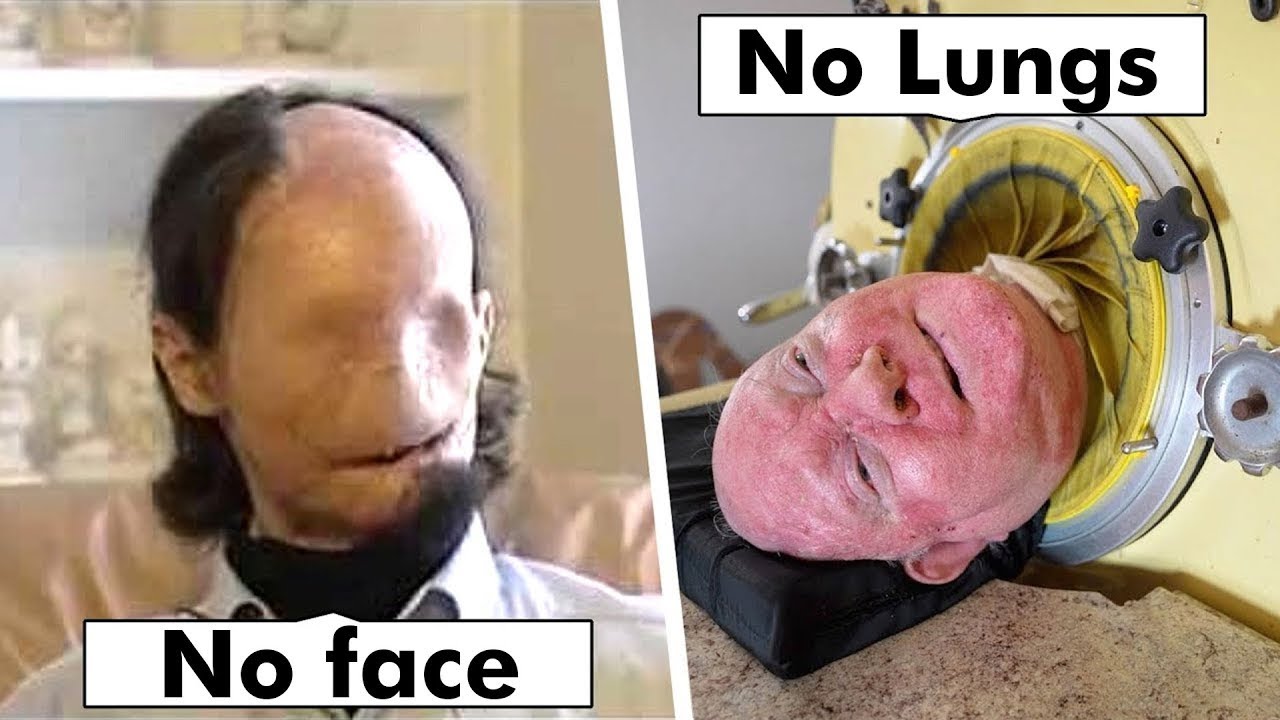 Unique People With Missing Body Parts