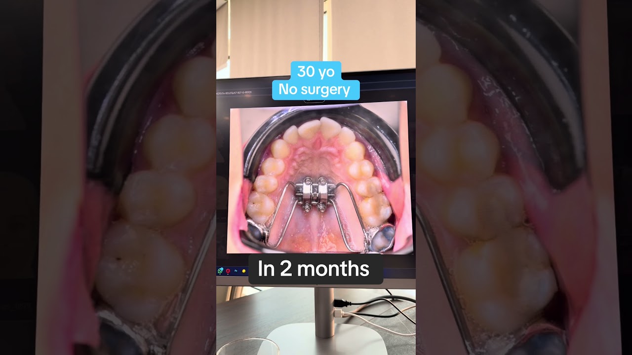 #безоперационноенет #храпанет #комфортпросто #храп #mse