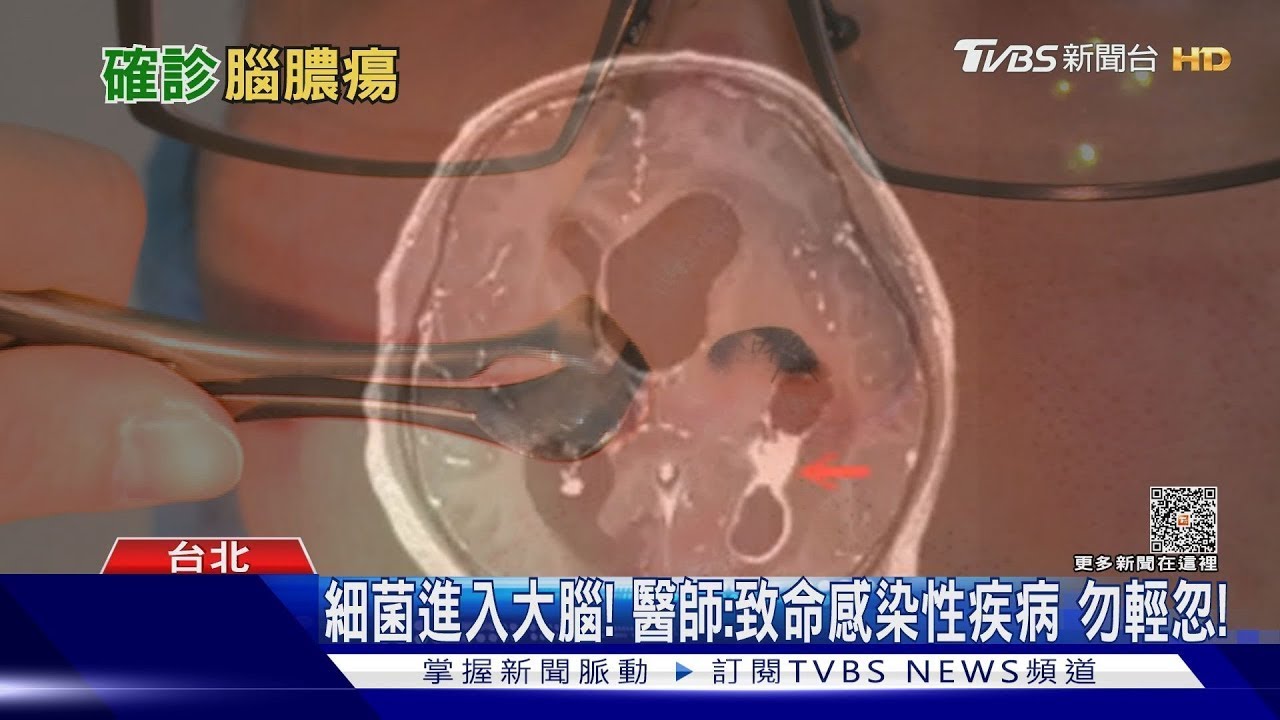 疏忽這件事 細菌透過血液進入腦部引發感染醫師：致命感染性疾病！｜十點不一樣20230706