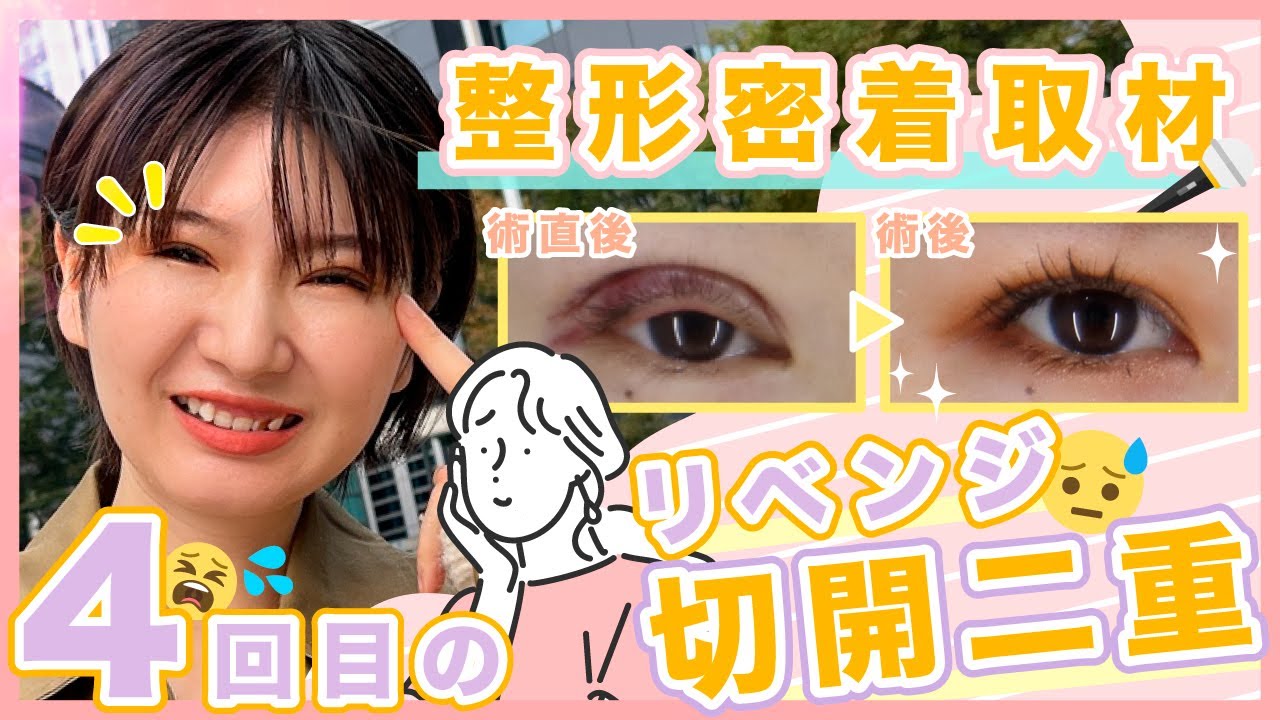 【二重整形】切開式の二重整形のダウンタイム含め大公開SP【切開法】