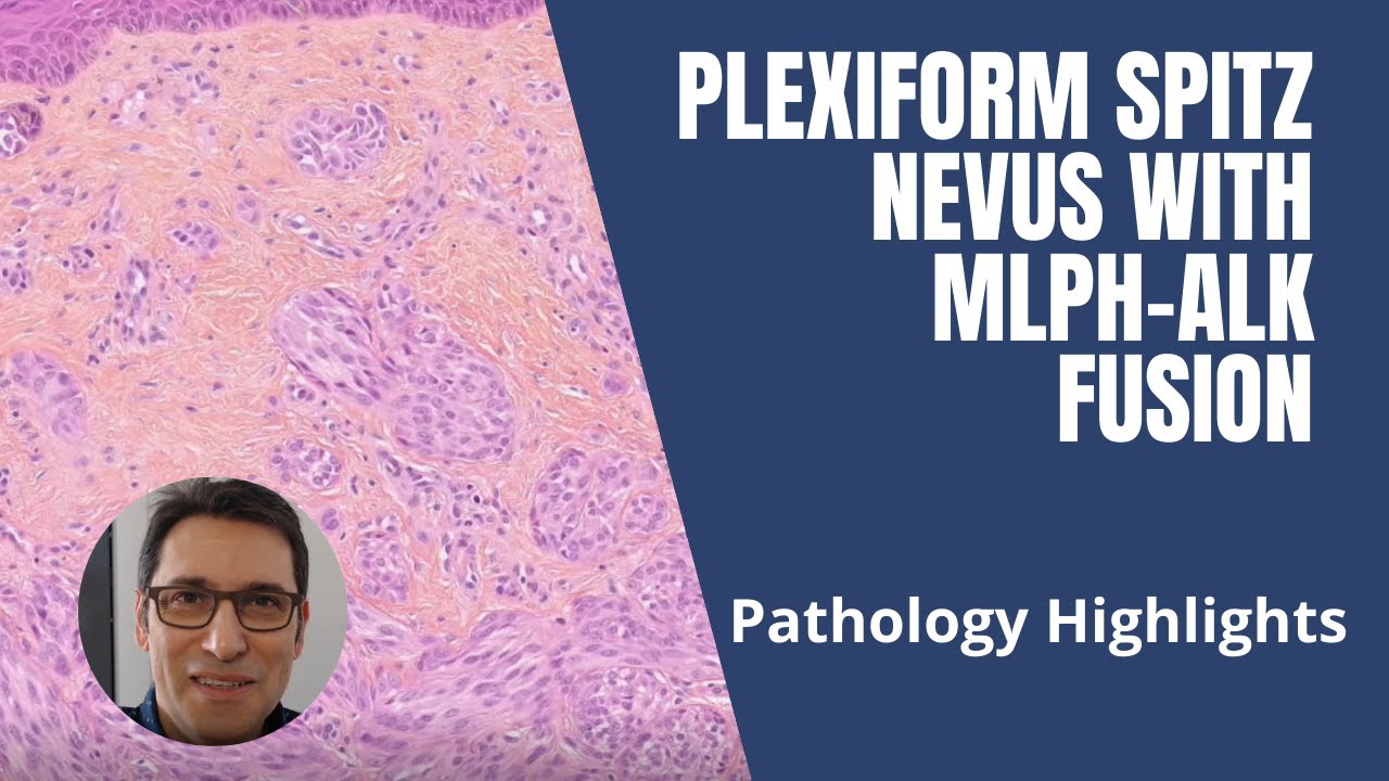 Pathology Highlights : plexiform Spitz nevus with a MLPH ALK fusion