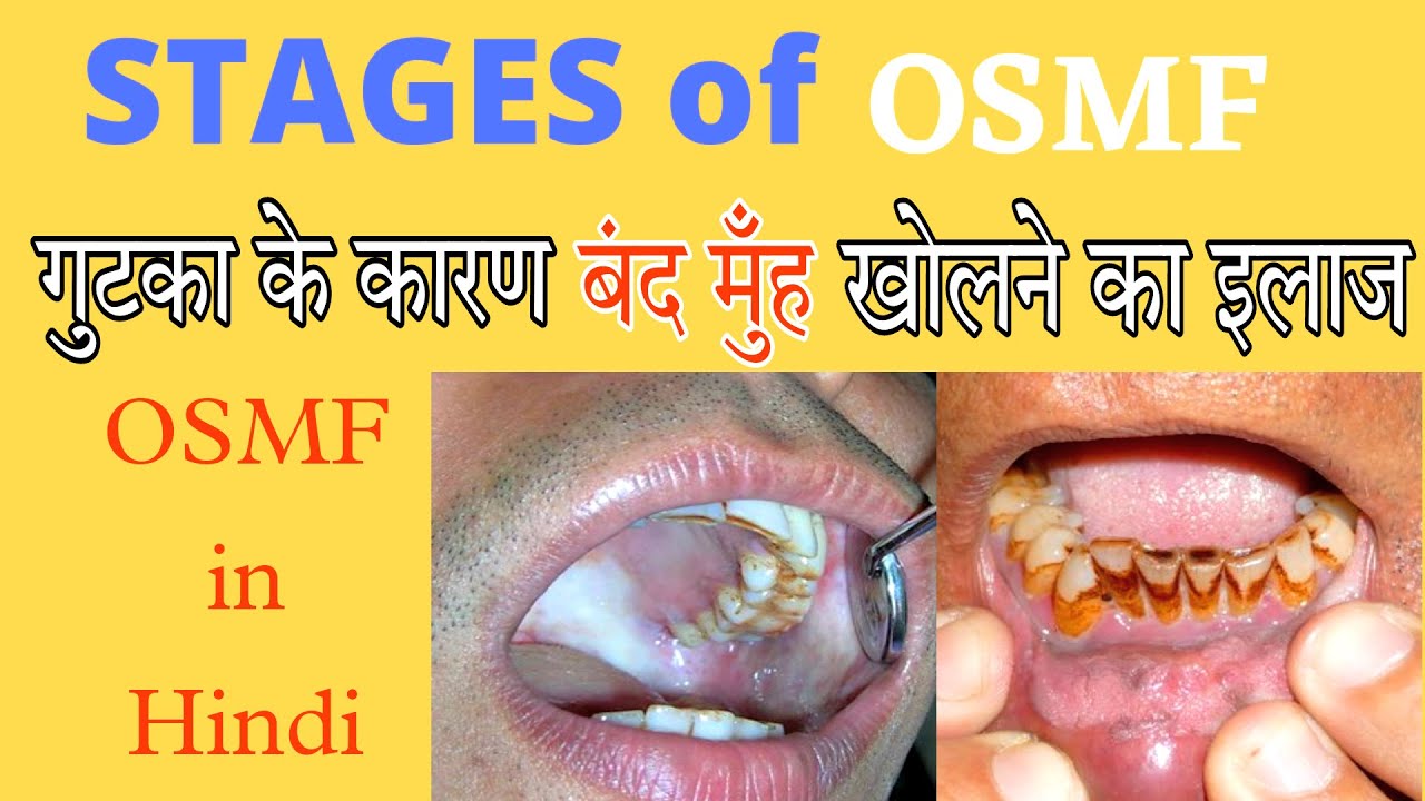 OSMF TREATMENT IN HINDI | OSMF Stages in hindi | oral submucous fibrosis in hindi | OSMF