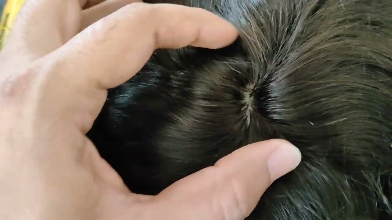 Original Mirage Hair Patch Vs Fake Mirage Hair Patch | Miraz Hair Patch for Men.