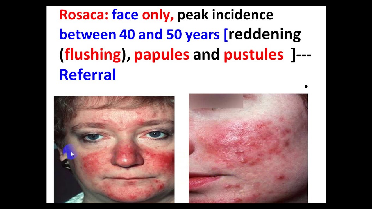 Acne. By Dr. Dheyaa Jabbar.