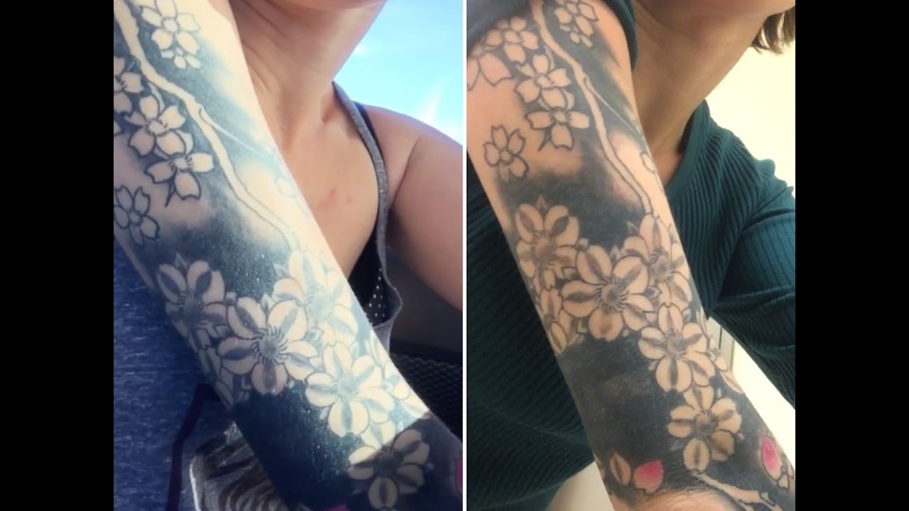 Laser Tattoo Removal Journey on a 3/4 Sleeve - 2nd Session