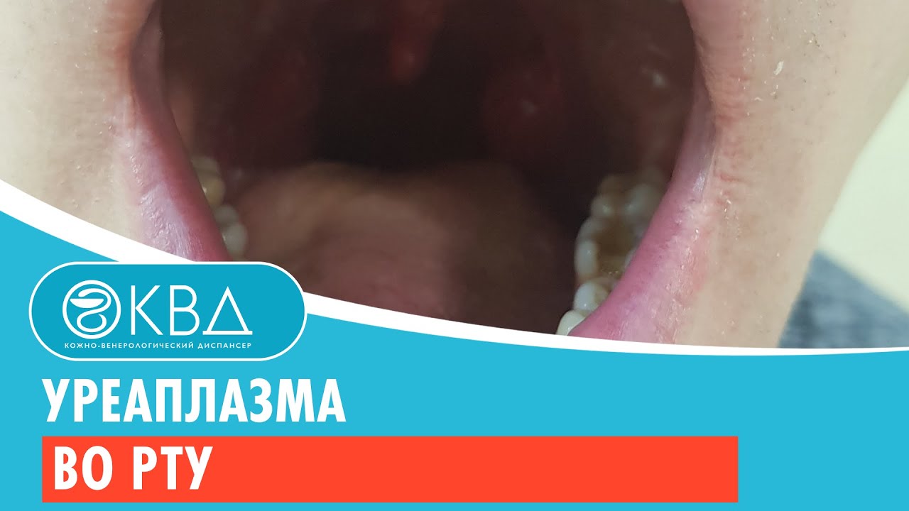 👅 Уреаплазма во рту. Клинический случай №297