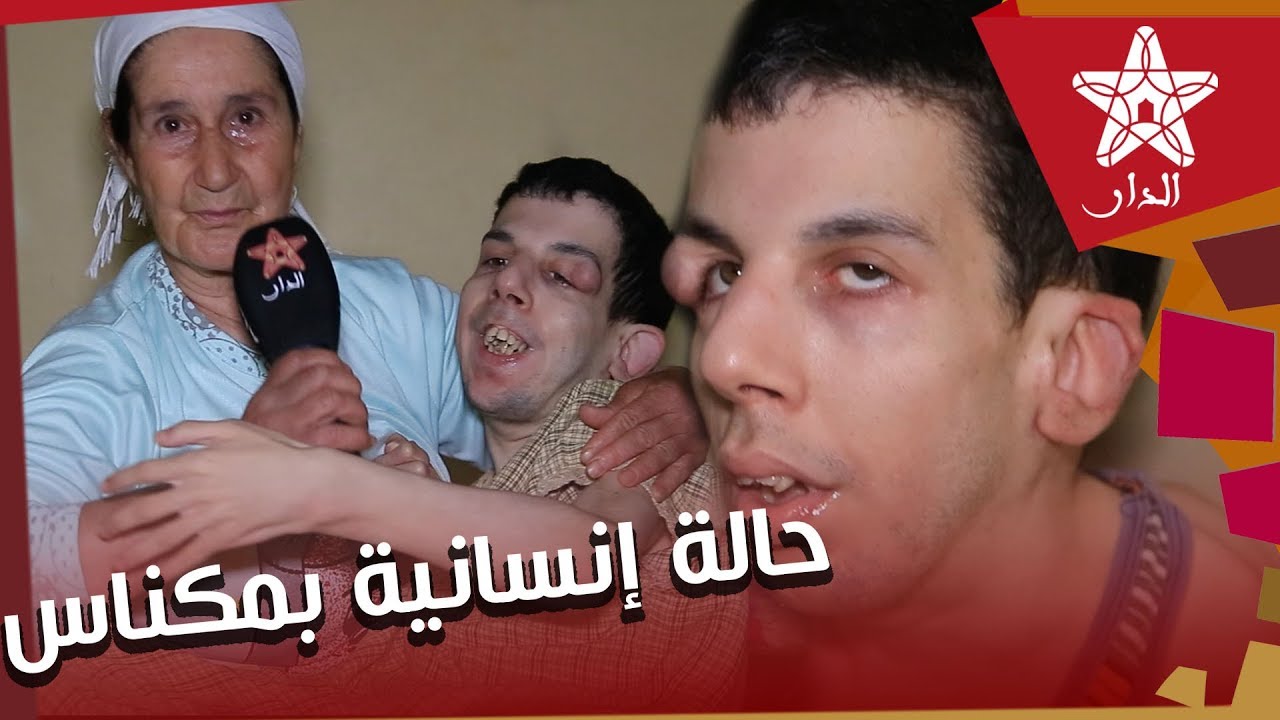 حالة إنسانية بمكناس تدمي القلوب.. أم ما خلات فين خدمات لإعانة ابنها المعاق وهو في حاجة ماسة لعملية