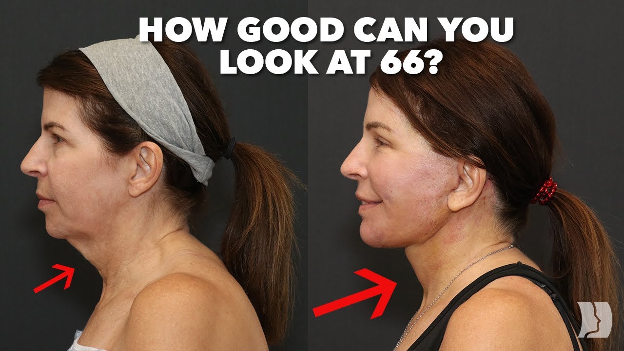 66 Year Old Gets Incredible Results with Omakase Facelift