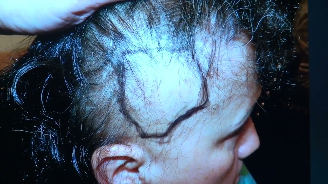 Female Hair Transplant 1-Year Follow-Up with Dr. John Diep | Natural & Dense Results