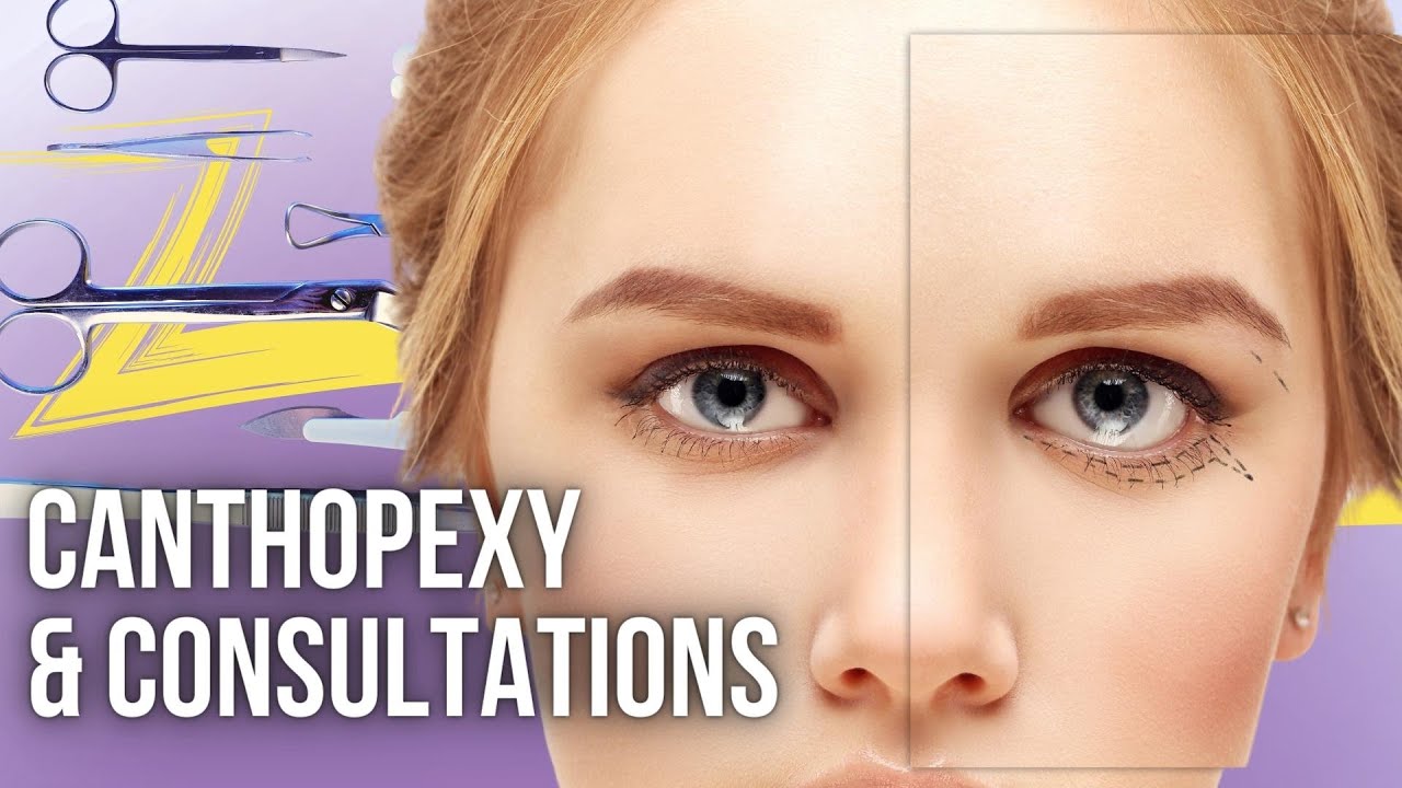 Canthopexy and Consultations | Lesson Of The Day