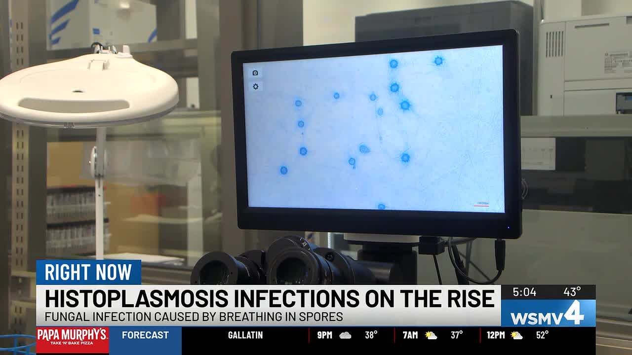 Nashville boy living with rare complication from histoplasmosis