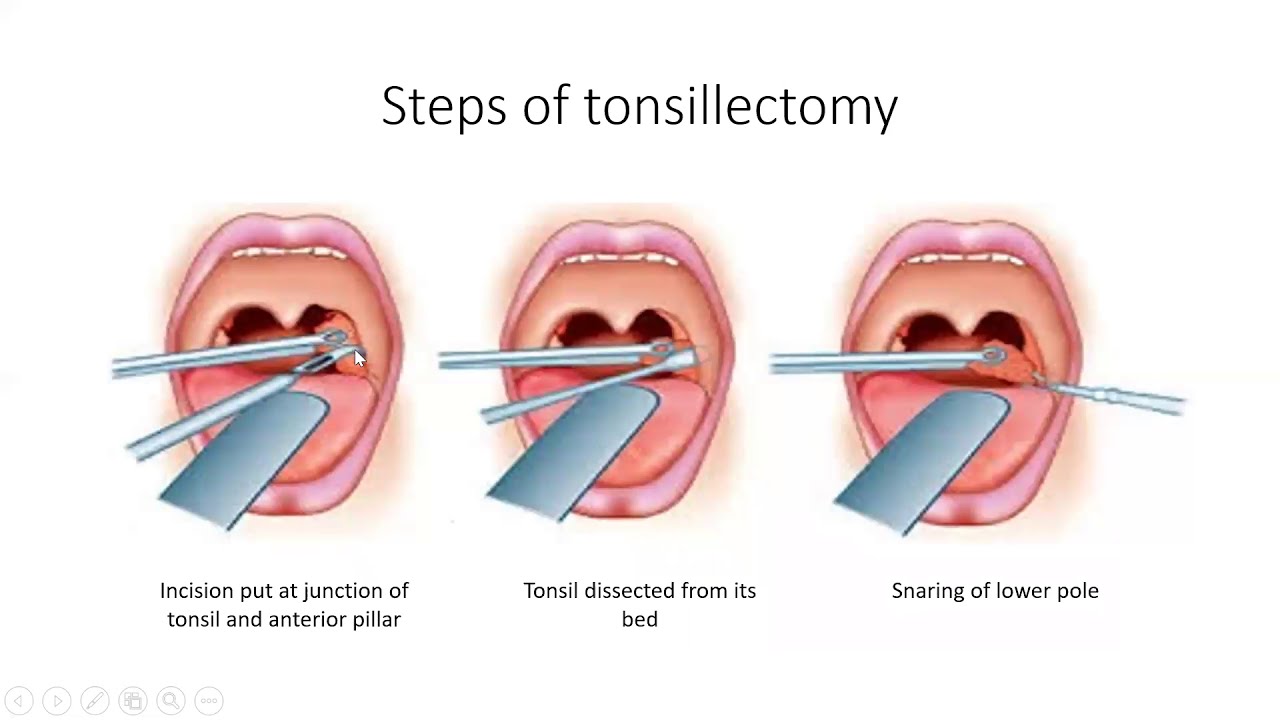 Tonsillectomy | ENT Lecture Series